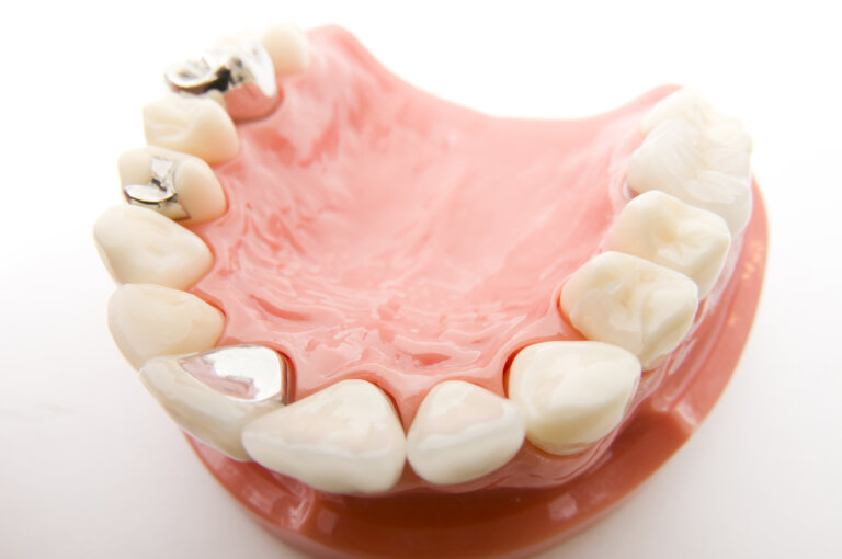 実は銀歯は危険？　より良い素材を選ぶためには
