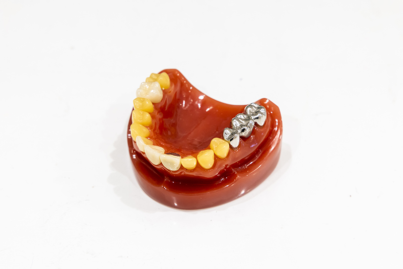 見た目が自然・噛める・ストレスフリーな入れ歯